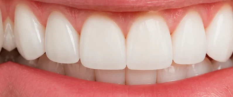 David's restored front tooth after single tooth implant treatment