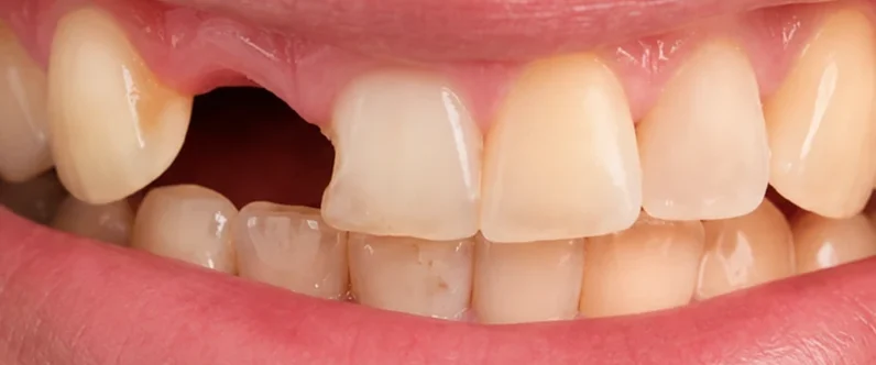 David's front tooth before single tooth implant treatment