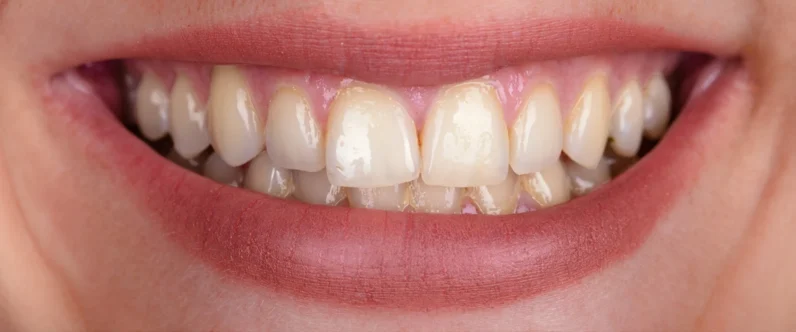 Sophie's smile before her smile makeover