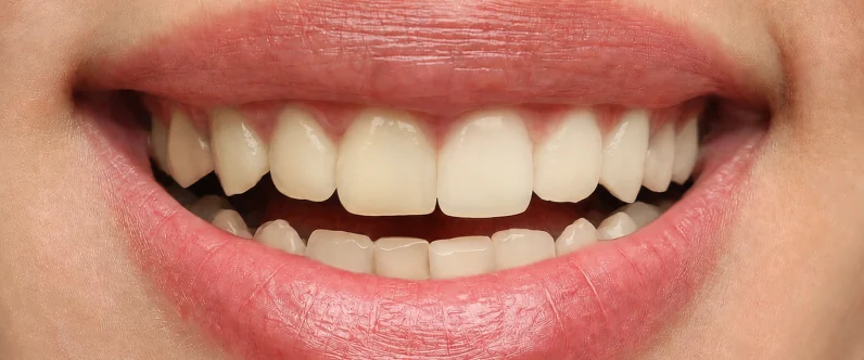 Sophie's teeth before her smile makeover