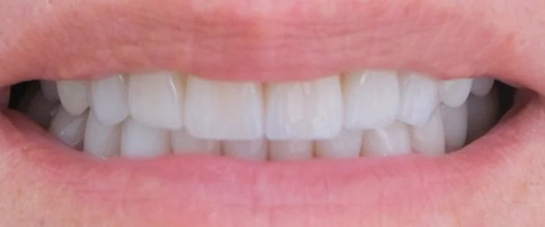 Emma's teeth after porcelain veneers treatment