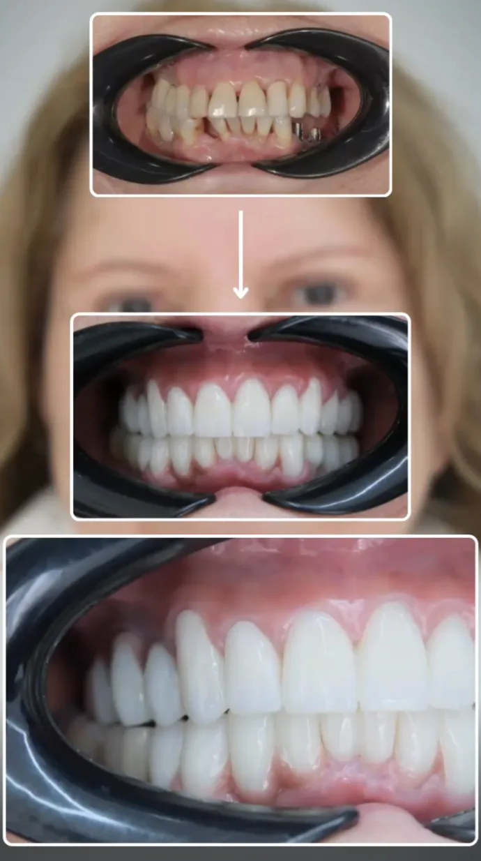 Before and after close-up of a dental smile transformation